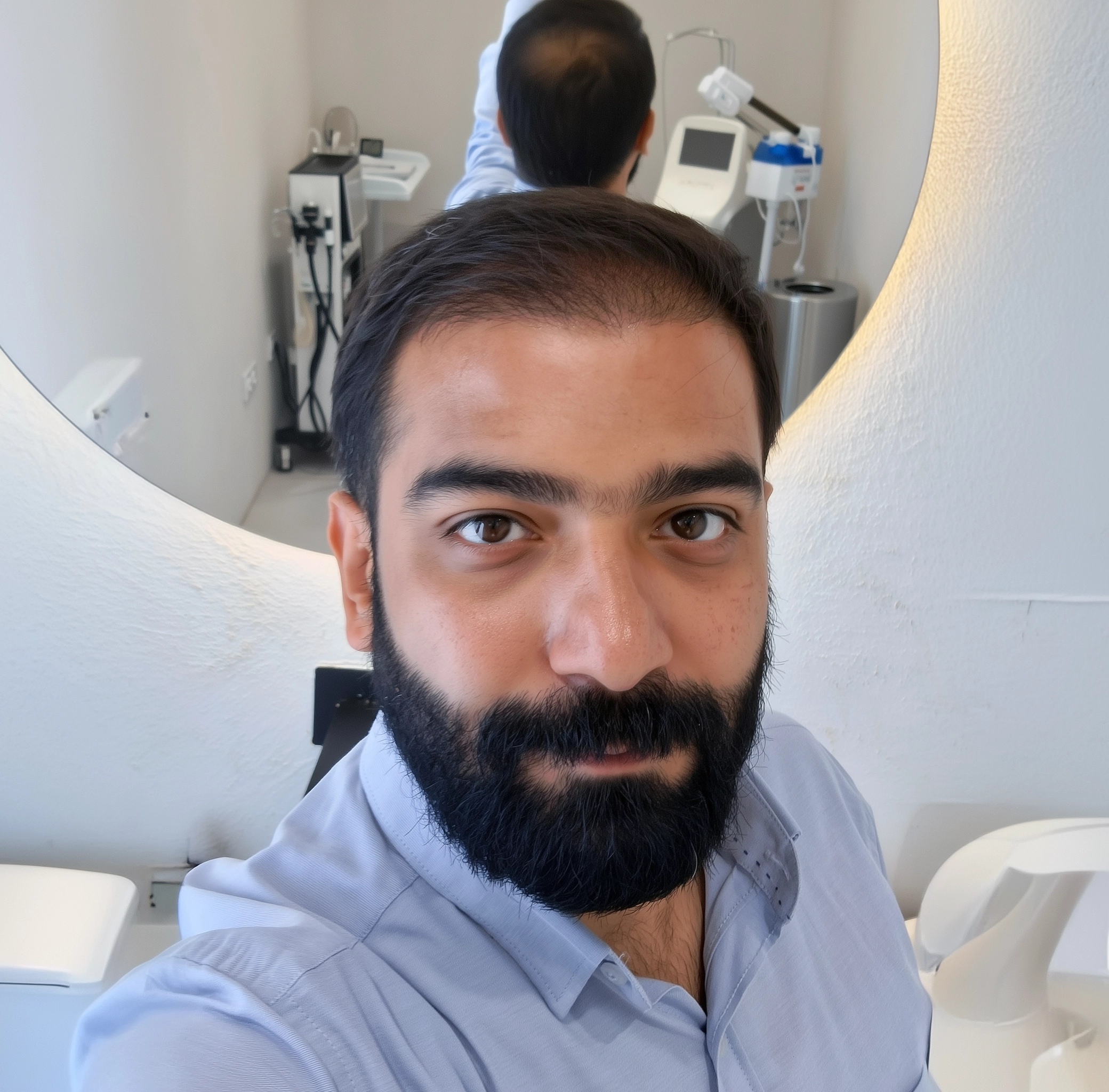 FUE Hair Transplant Procedure Benefits Cost FUE Hair Transplant Procedure Benefits Cost