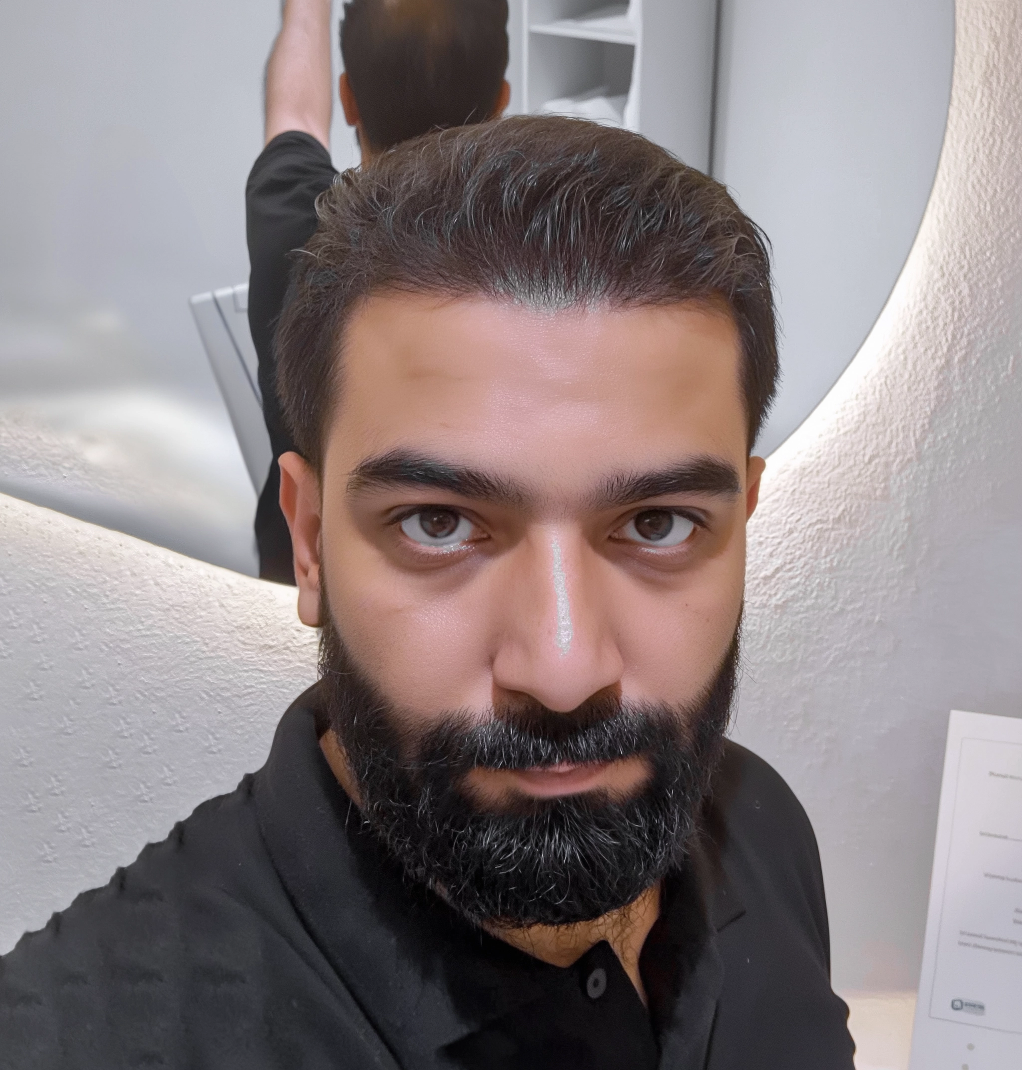 FUE Hair Transplant Procedure Benefits Cost FUE Hair Transplant Procedure Benefits Cost