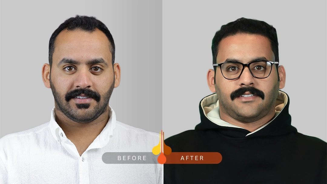 Hair Transplant in Padra