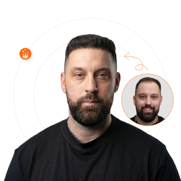 Hair Transplant in Padra