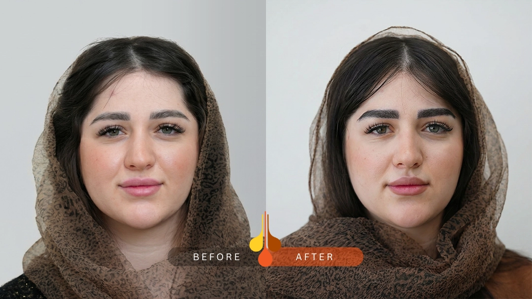 result of eyebrow transplant