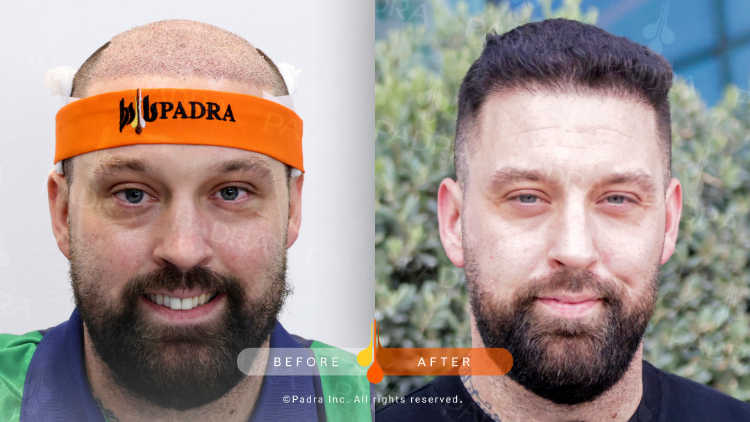 Before and after FUE hair transplant results at Padra Clinic Qatar