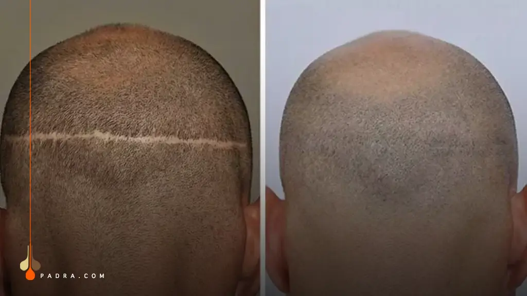 FUT Hair Transplant scar