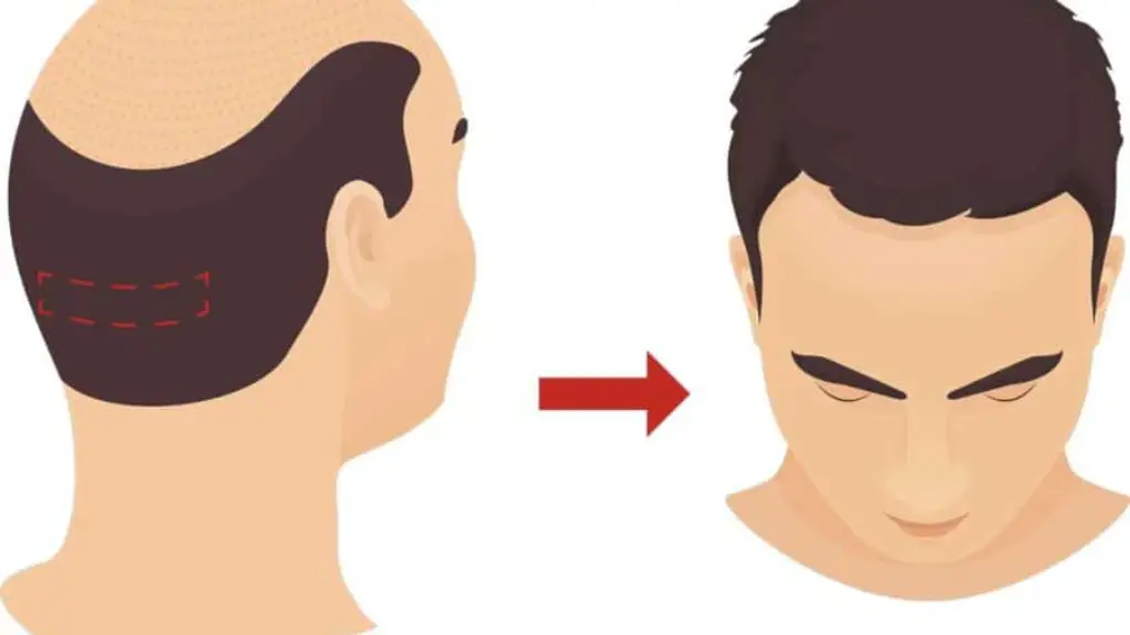 FUT Hair Transplant