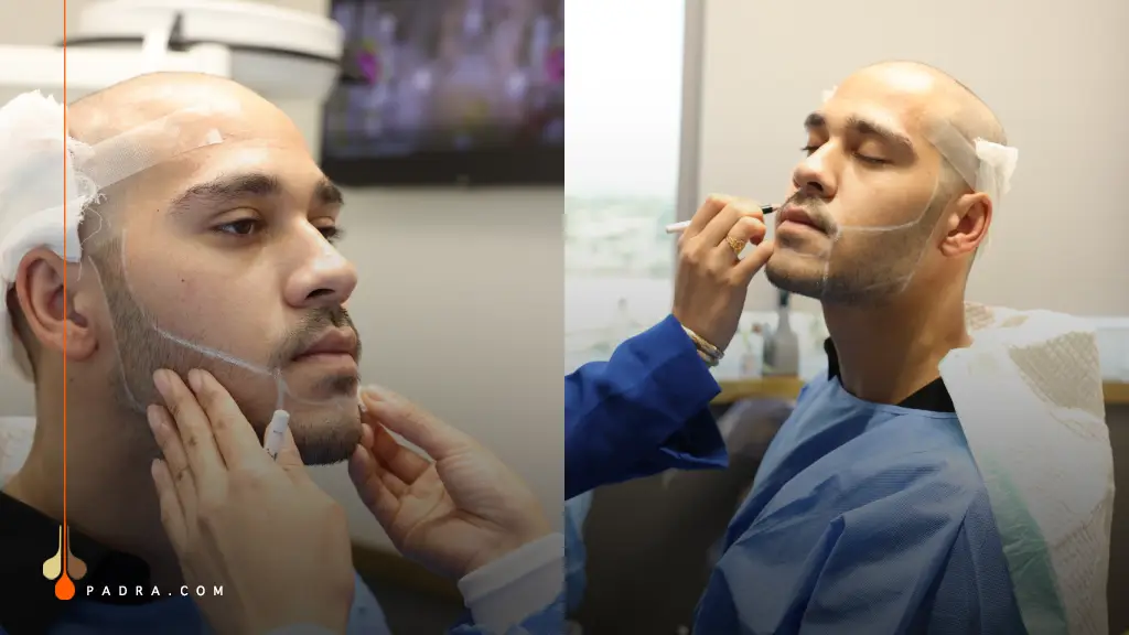 Beard Transplant Procedure