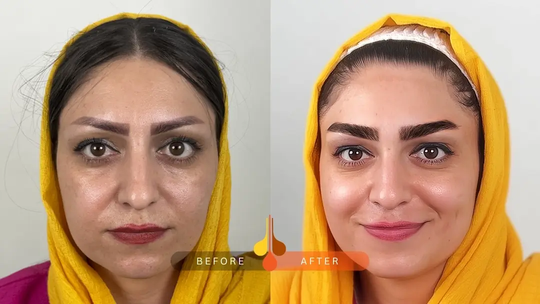 eyebrow transplant before and after: sample 2