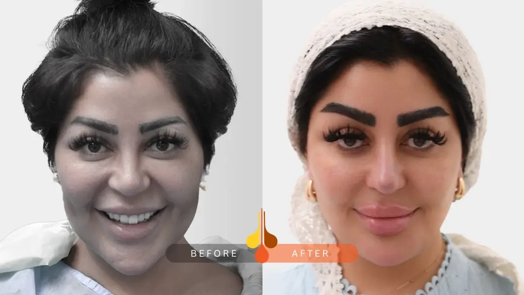 eyebrow transplant before and after: sample 3