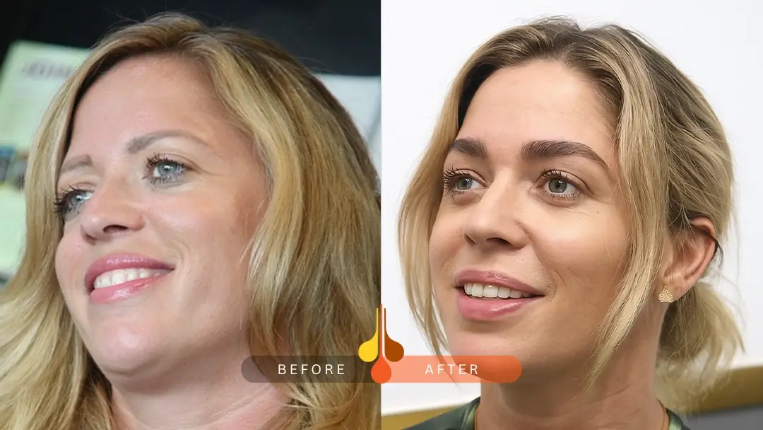 eyebrow transplant before and after: sample 4