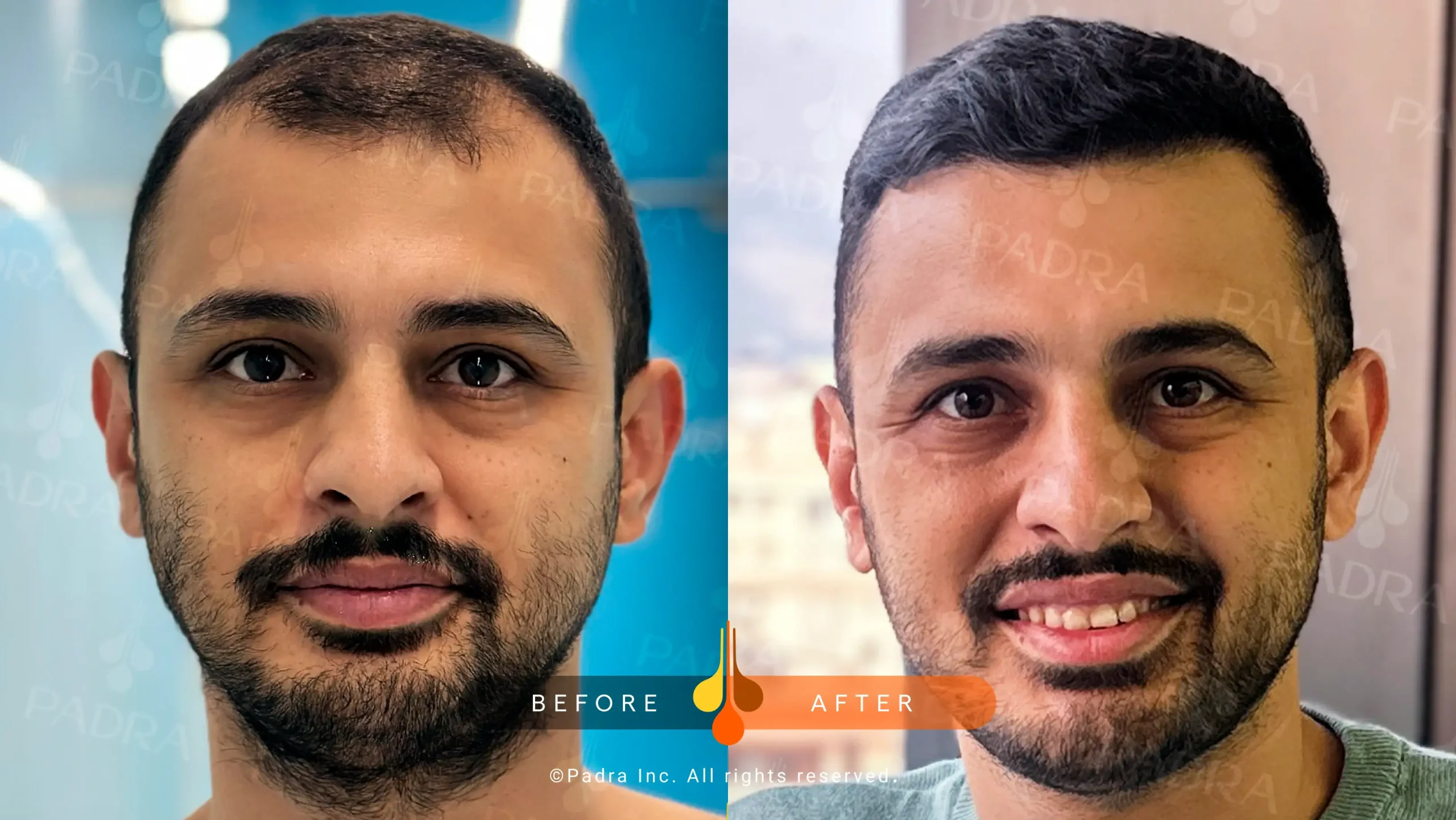 hair transplant before and after in Dubai