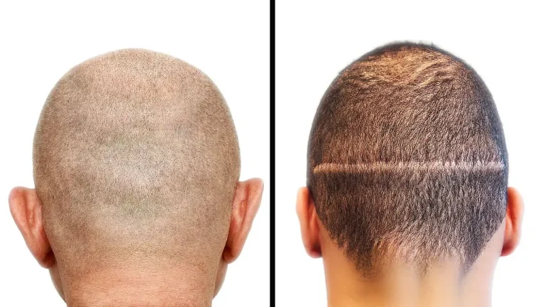 FUE vs FUT hair transplant