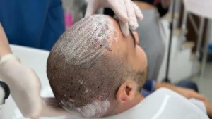 washing head after hair transplant