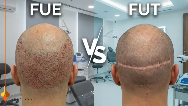 FUE vs FUT