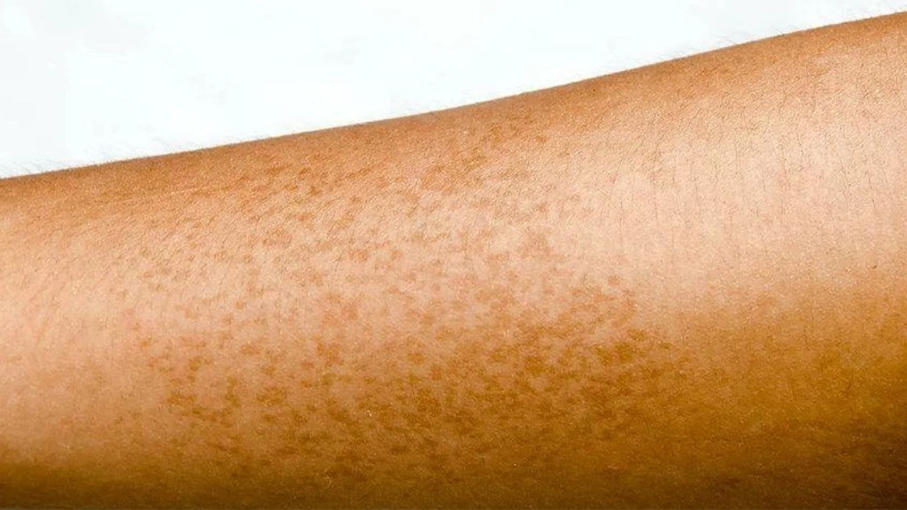 Pigmentation changes after Laser Hair Removal