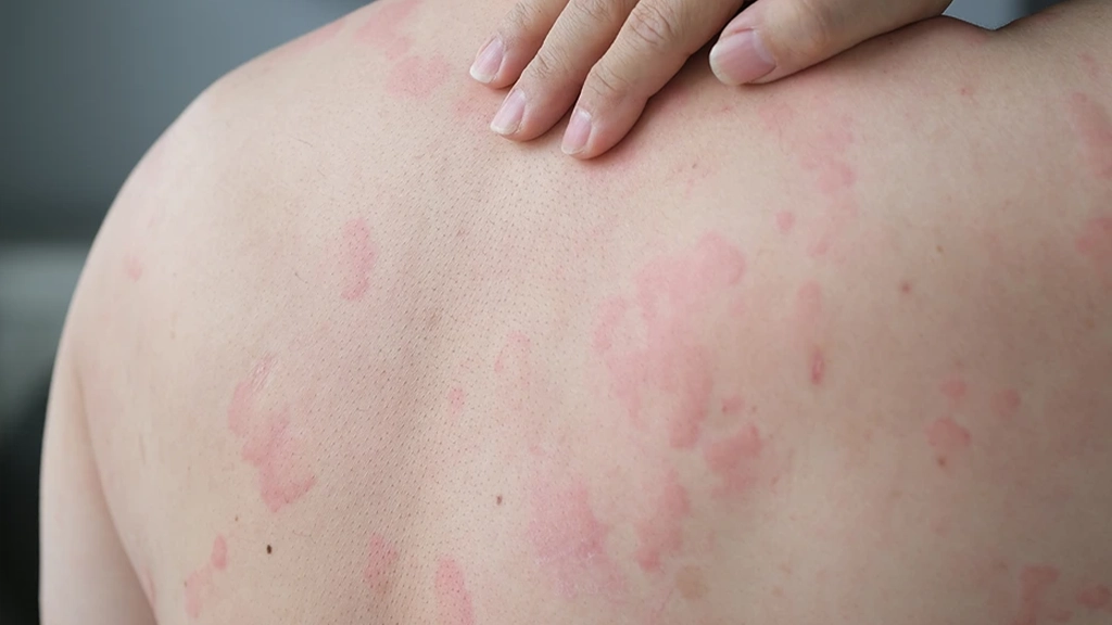 Skin irritation after Laser Hair Removal