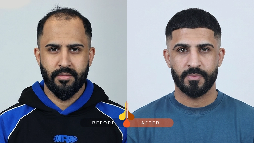 Hair Transplant in Padra 4