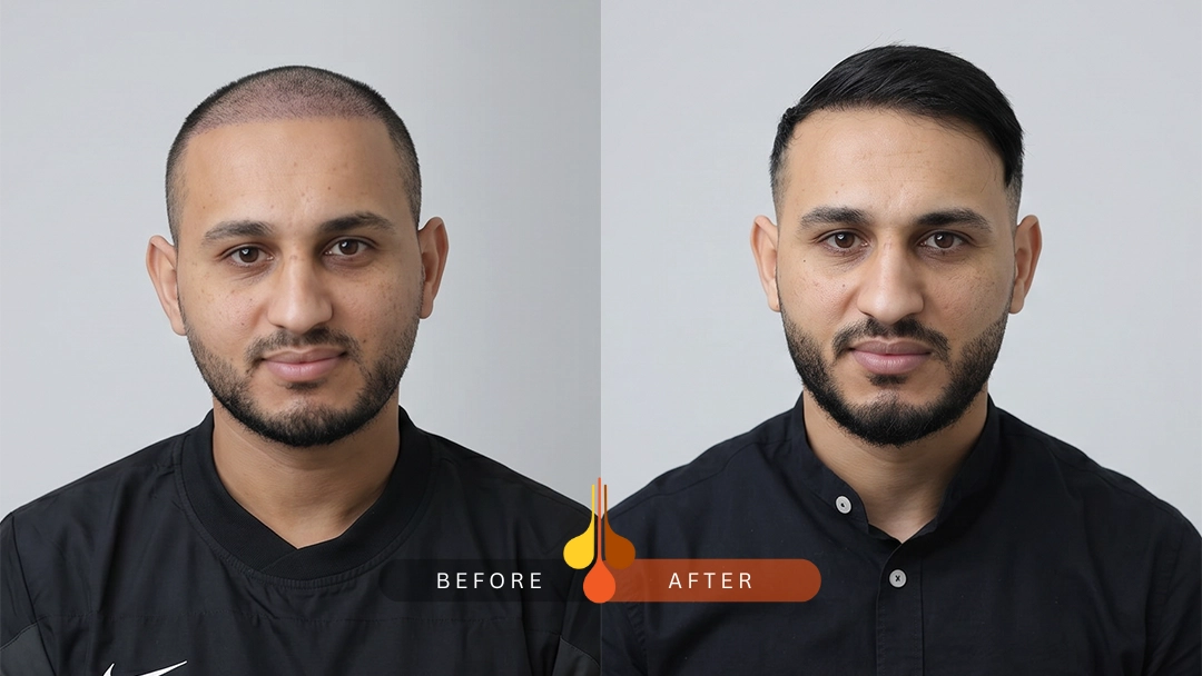 hair transplant in Dubai at Padra Clinic