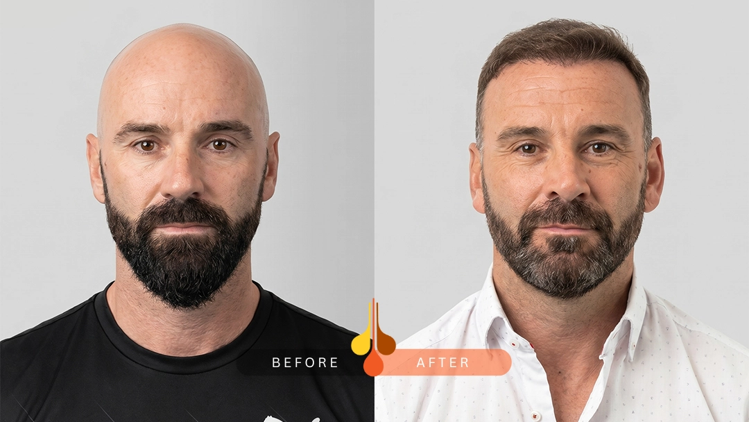 Hair Transplant in Padra 1