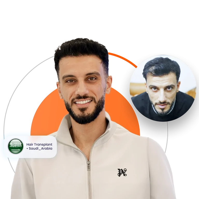 زراعة الشعر في السعودية