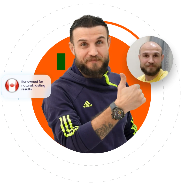 hair transplant in Canada