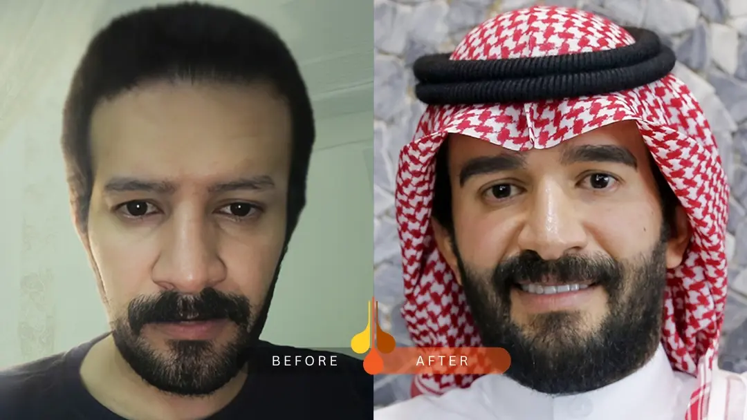 زراعة الحواجب قبل و بعد