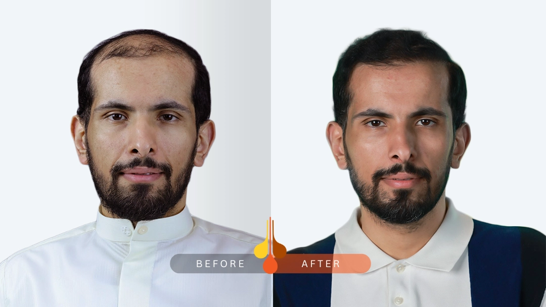 hair transplant Kuwait before and after