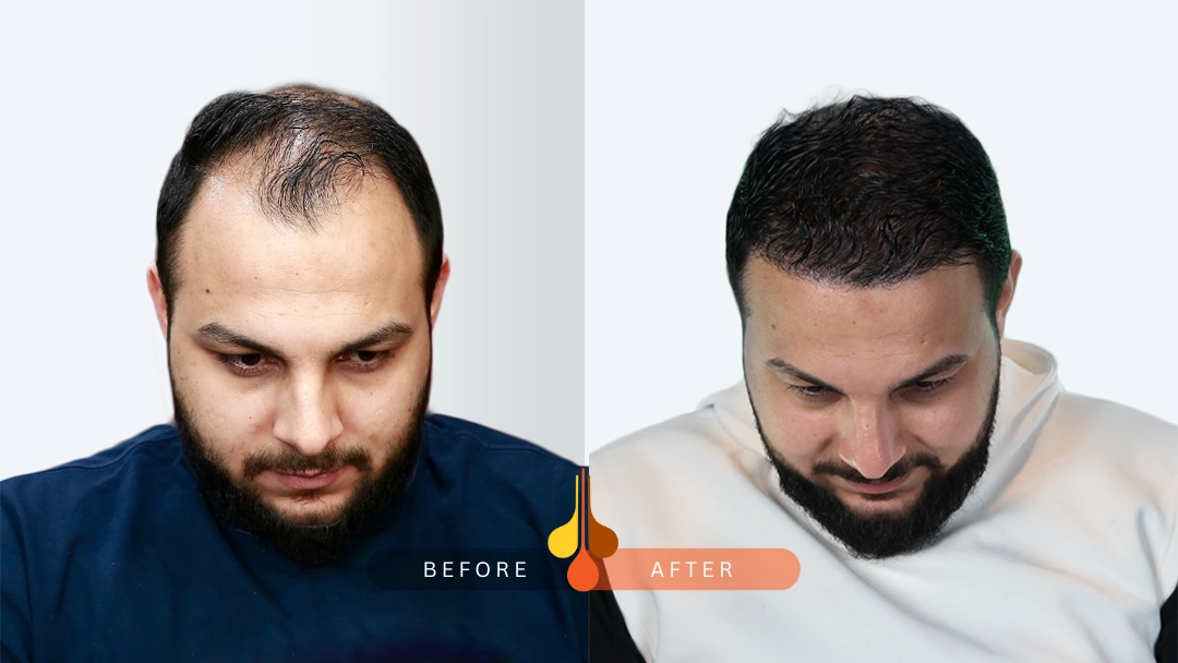 hair transplant Kuwait before and after