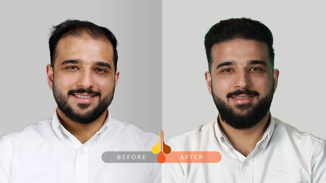 hair transplant Kuwait before and after