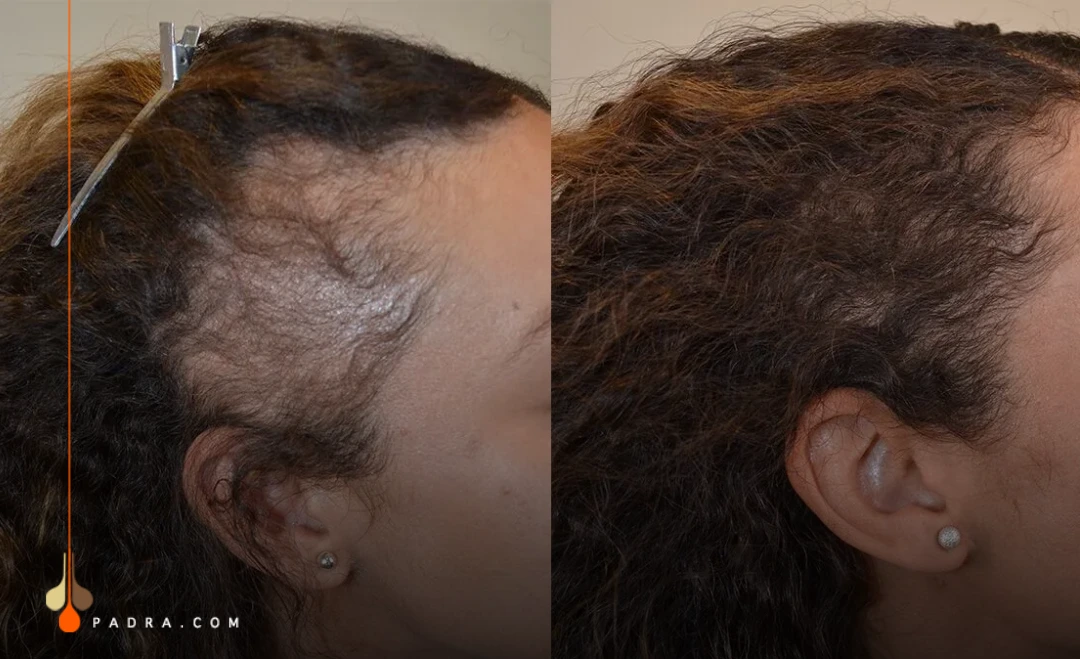woman before and after hair transplant