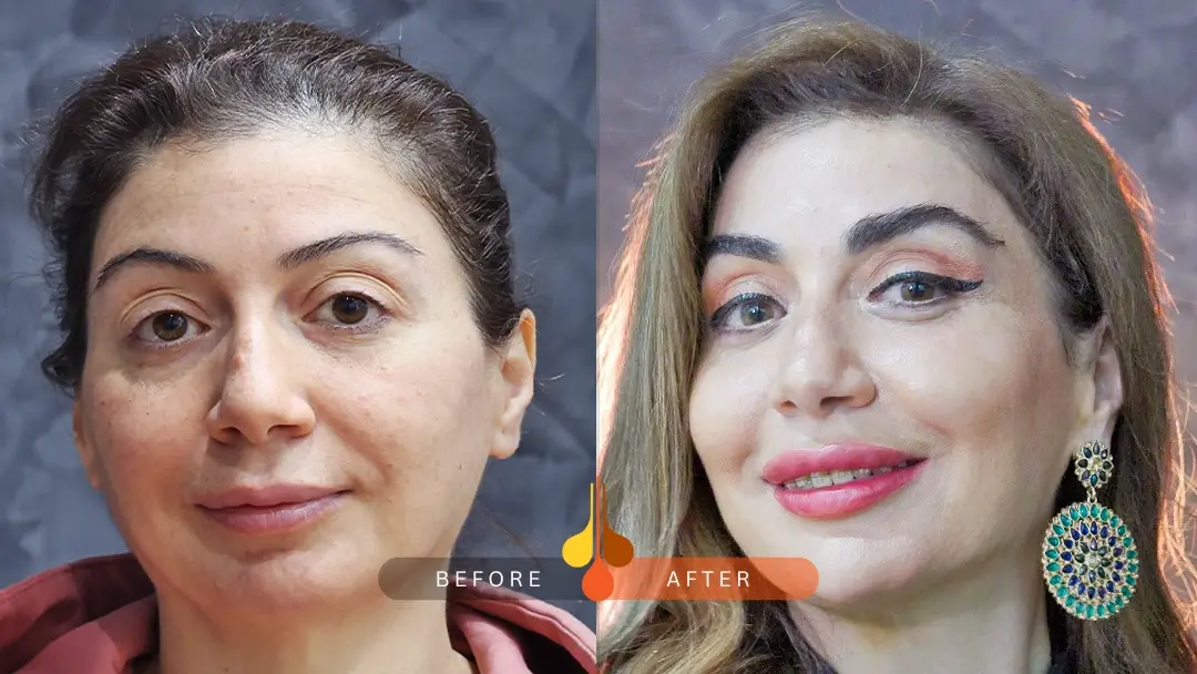 زراعة الحواجب قبل و بعد