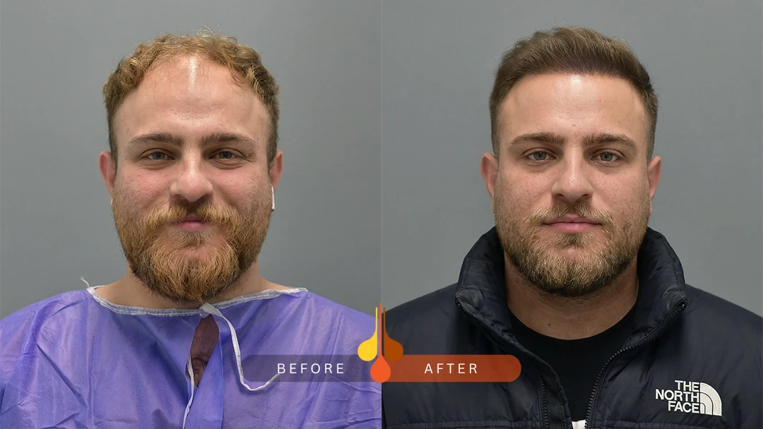 hair-transplant-before-after-6