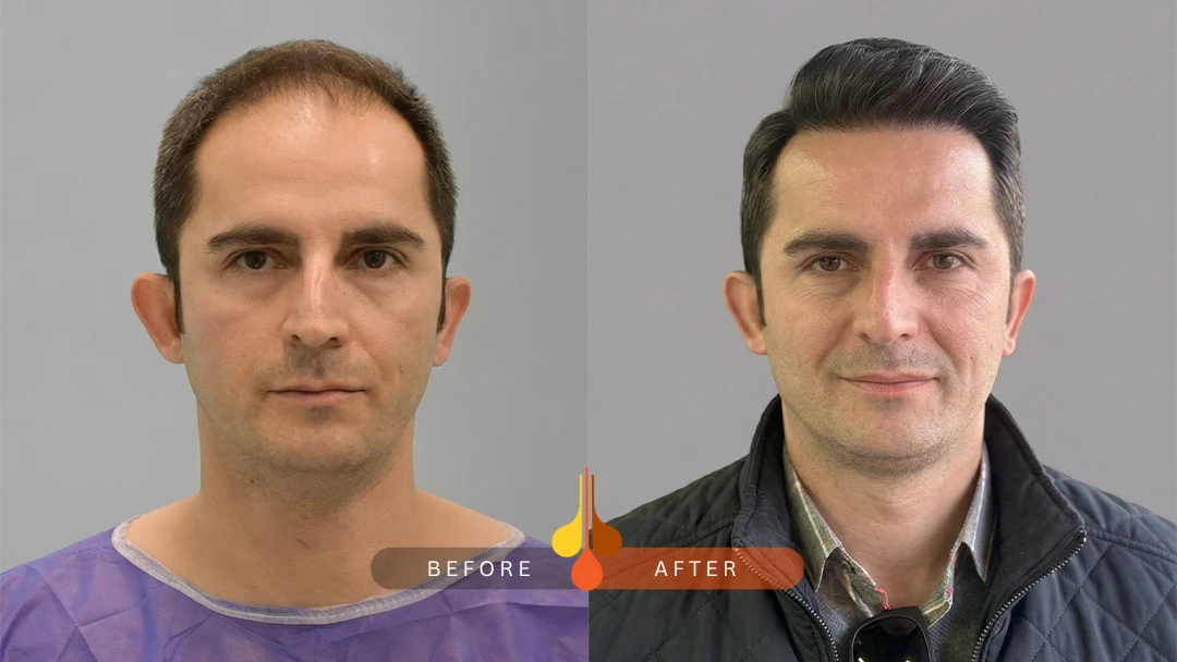 result of hair transplant in Riyadh