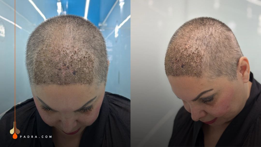 woman with shaved head after hair transplant