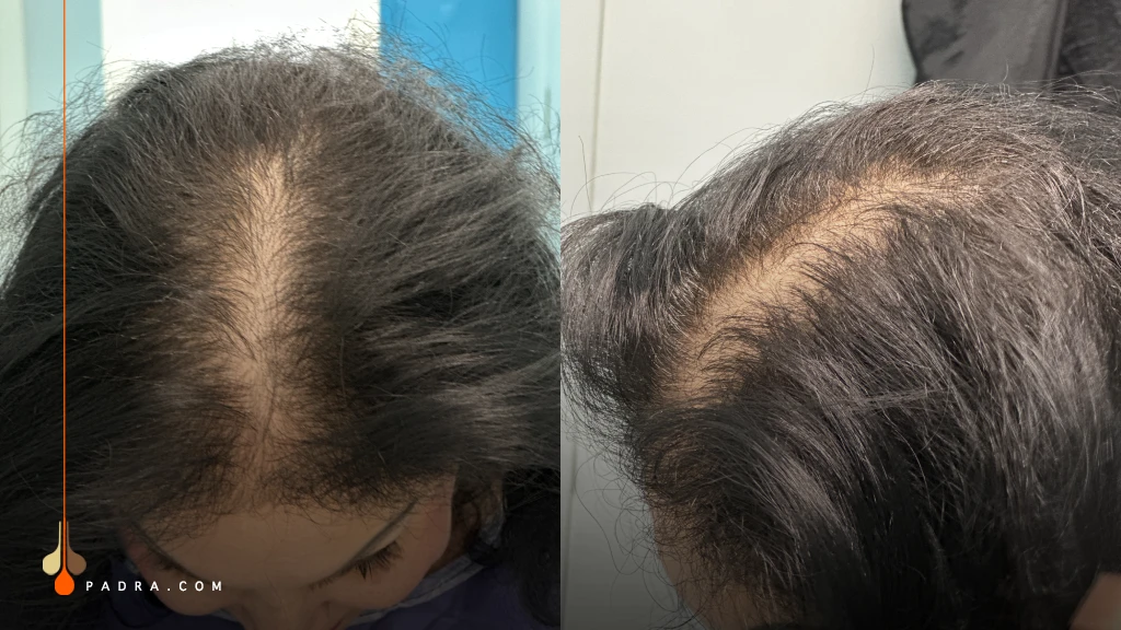 woman with diffuse hair loss