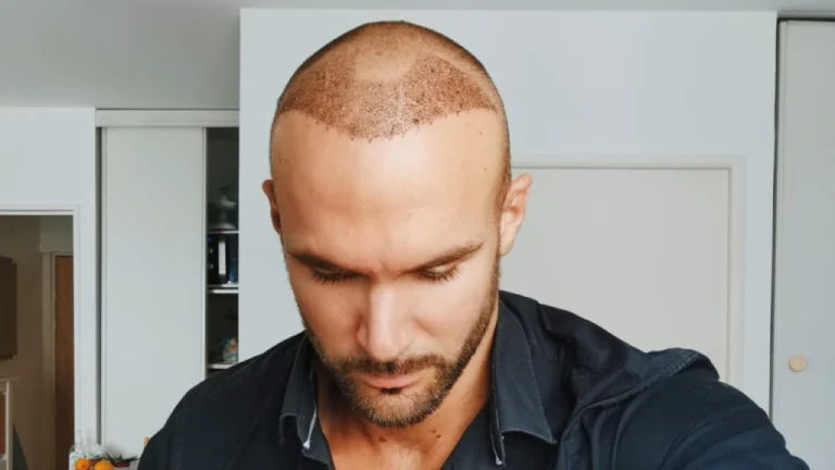 hair transplant after 3 weeks