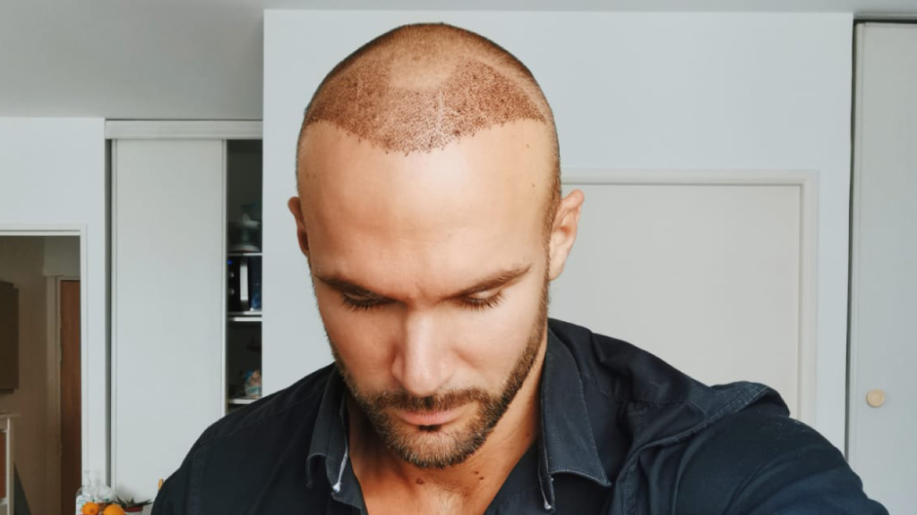 hair transplant after 3 weeks