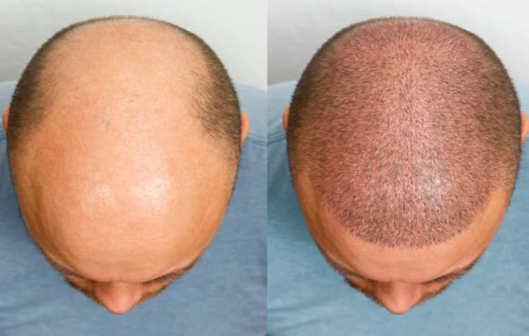 hair transplant after 1 month