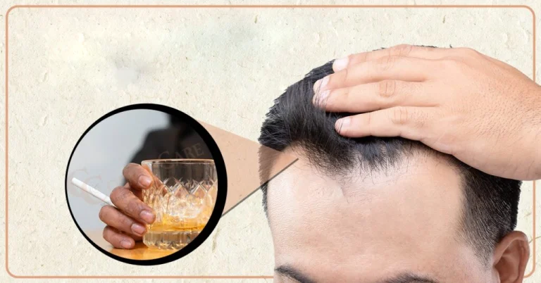 The effect of smoking and alcohol after hair transplantation