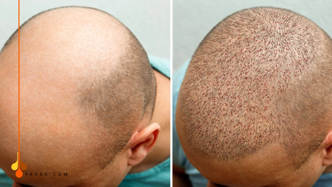bleeding after hair transplant