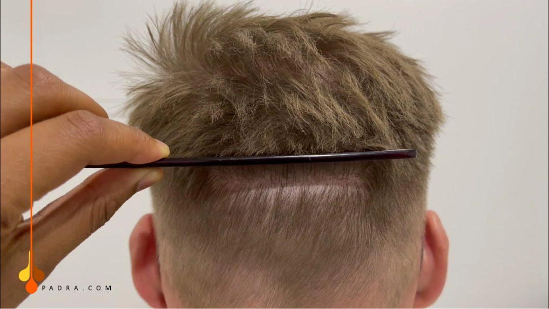 linear scar after fut hair transplant