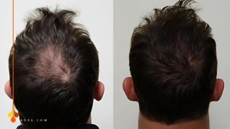 artificial hair transplant