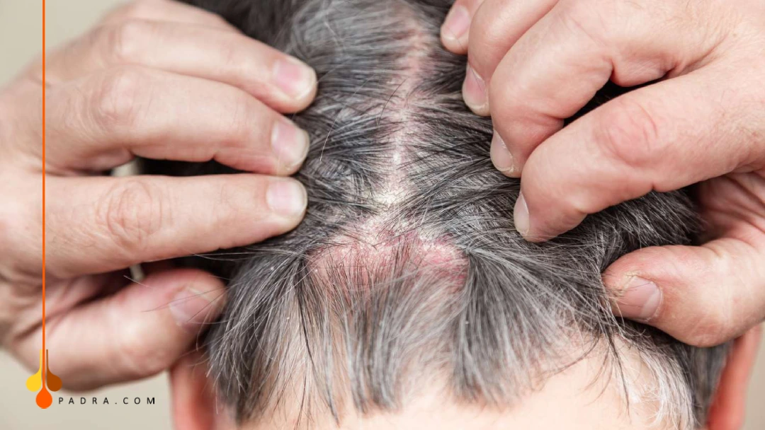 scalp psoriasis