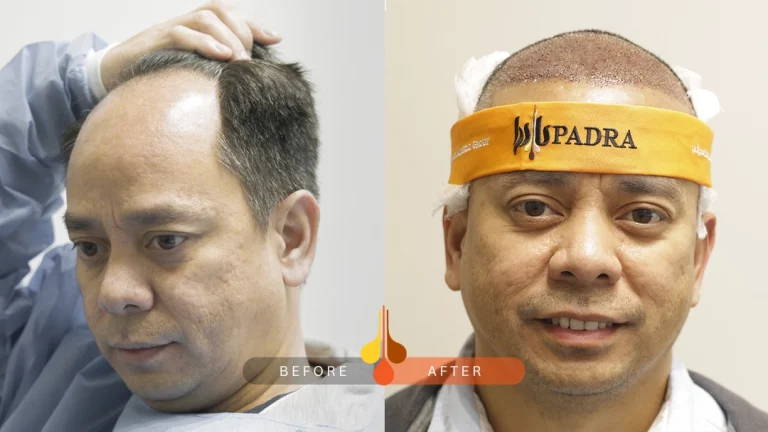 شكل الراس بعد زراعة الشعر