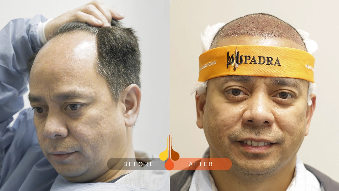 شكل الراس بعد زراعة الشعر