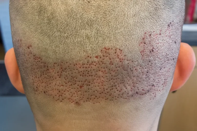 inflammation of the donor area