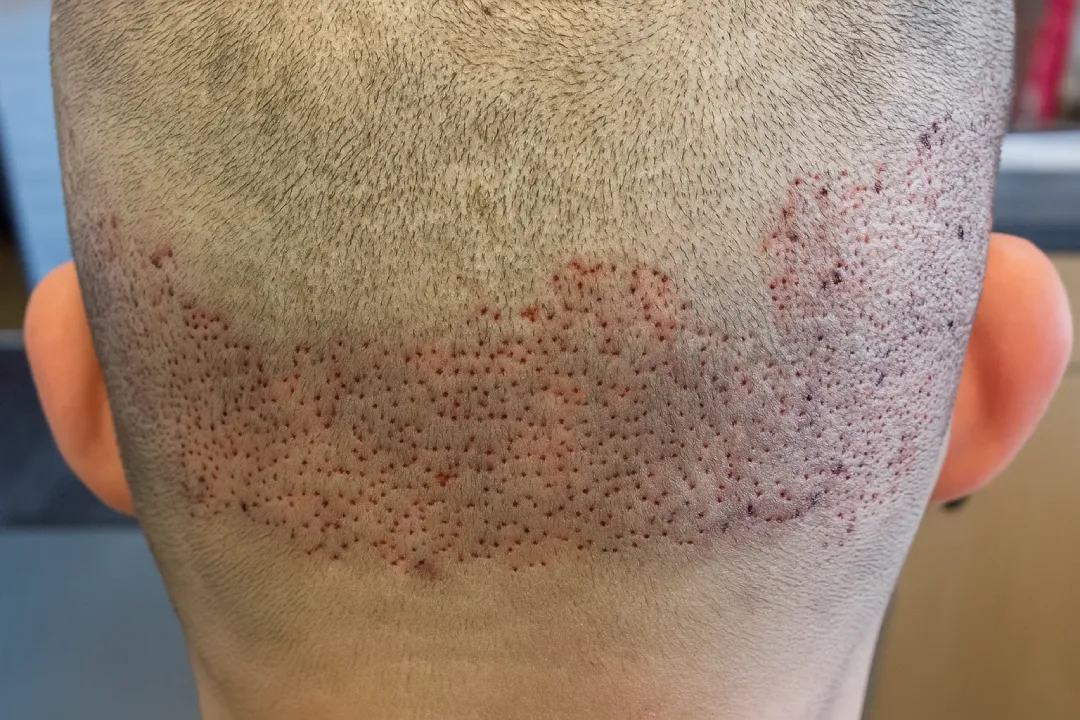 inflammation of the donor area