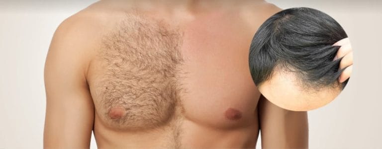 body-hair-transplant