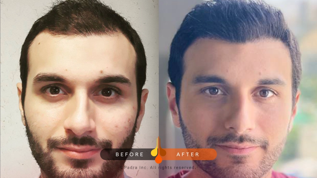 نموذج من زراعات الشعر بدون حلاقة