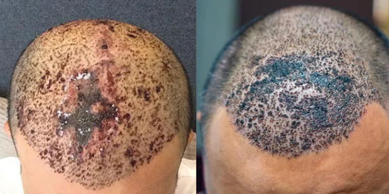 Long-term damage of hair transplantation