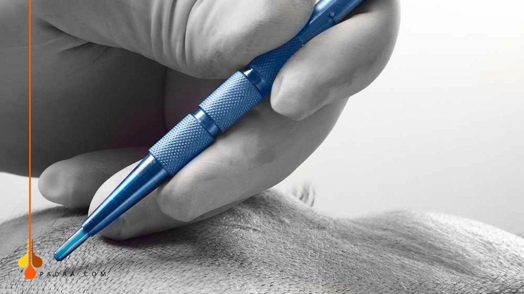 تقنية السفر لزراعة الشعر