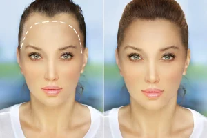 نسبة نجاح زراعة الشعر للنساء